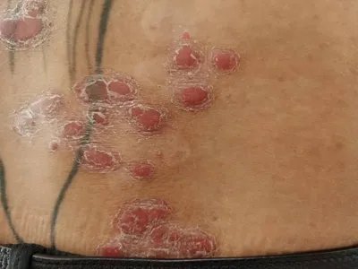 寻常型银屑病腰部红斑图片