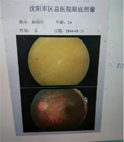 注玻尿酸双眼失明 打完玻尿酸需要注意什么?