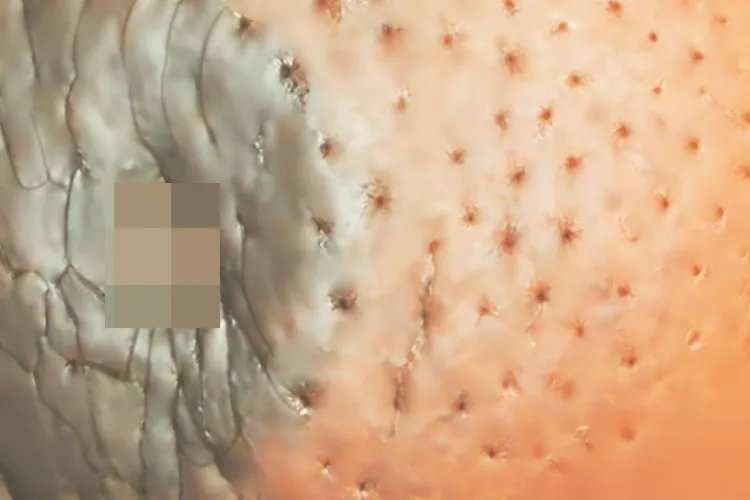 乳腺癌晚期真人图片