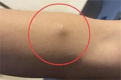 胳膊皮脂腺囊肿图片