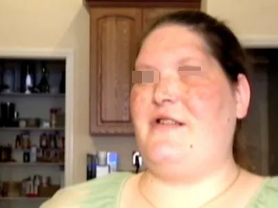 巨人症症状图片