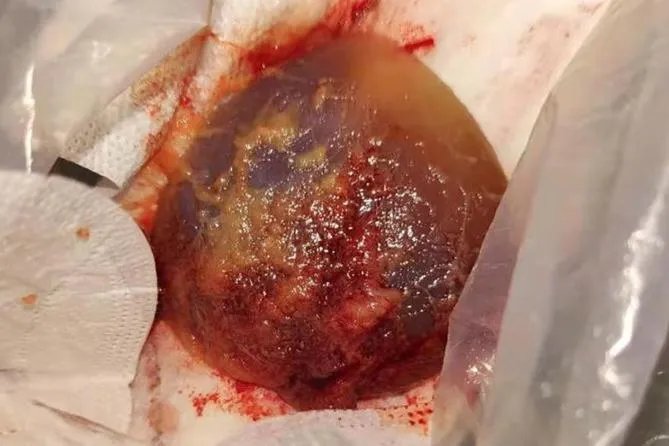 孕囊排出来是什么样子图片