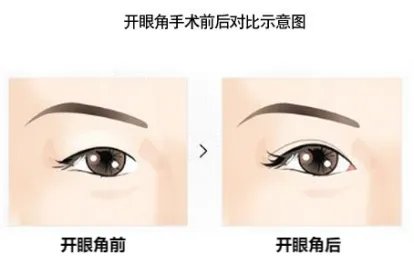 开眼角对比图