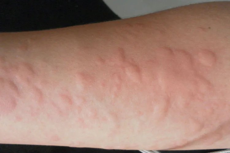 轻微海鲜过敏症状图片