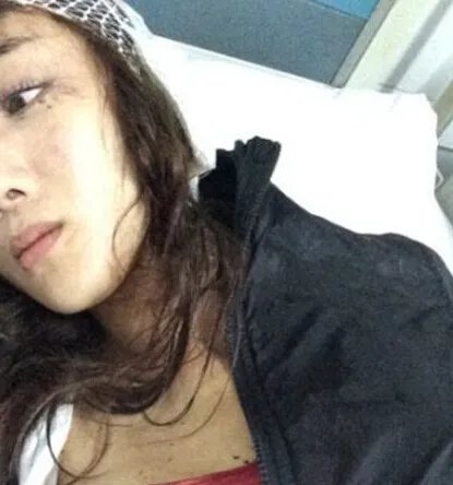 李依晓被叶璇狗咬图片触目惊心 揭秘事件始末