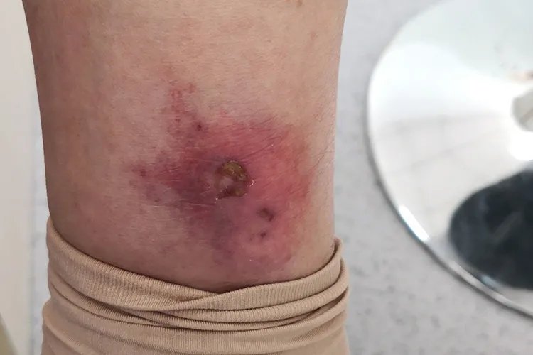 丹毒的症状图片