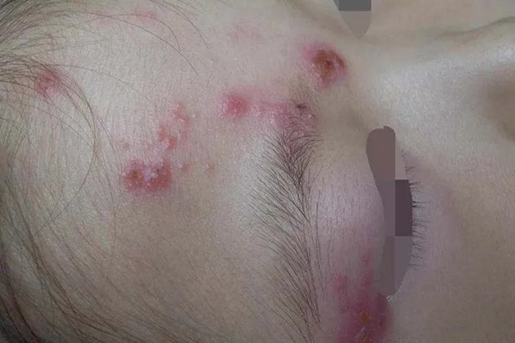 儿童蛇胆疮图片大全