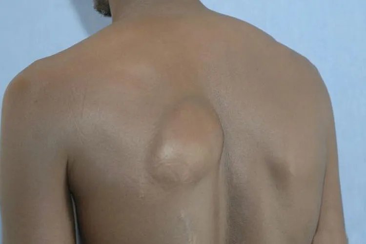 皮肤脂肪瘤图片实拍