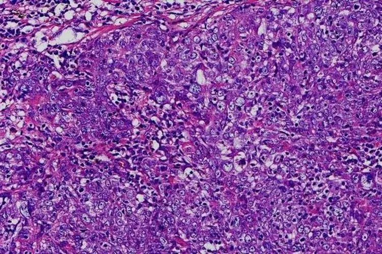 癌细胞真实图片