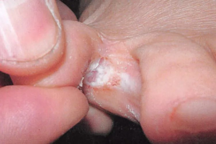 脚上起癣的图片和症状