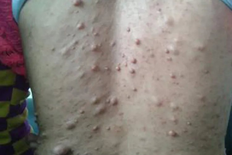 皮肤脂肪瘤图片实拍