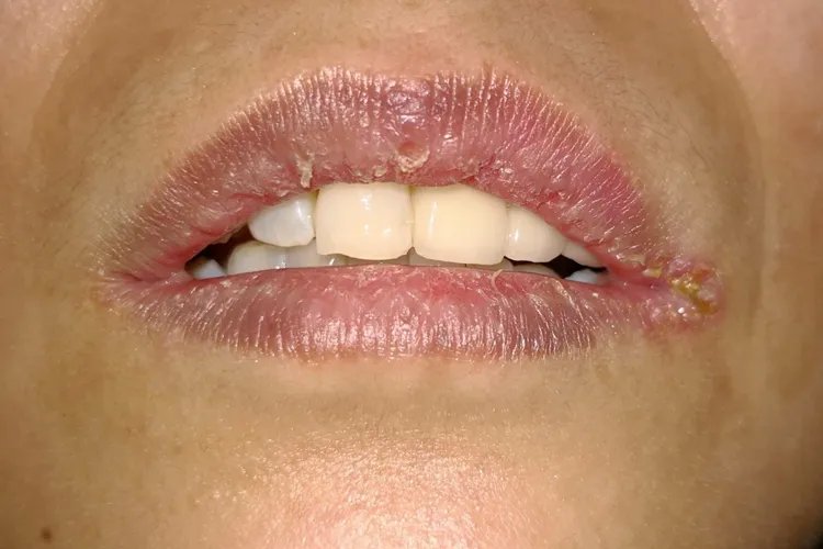 口腔白色念珠菌图片