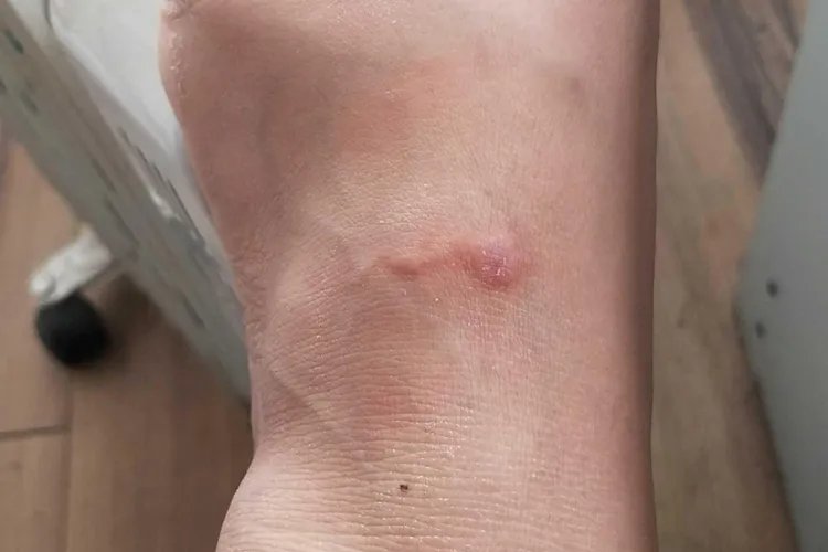 脚面上起了一片小红疹图片