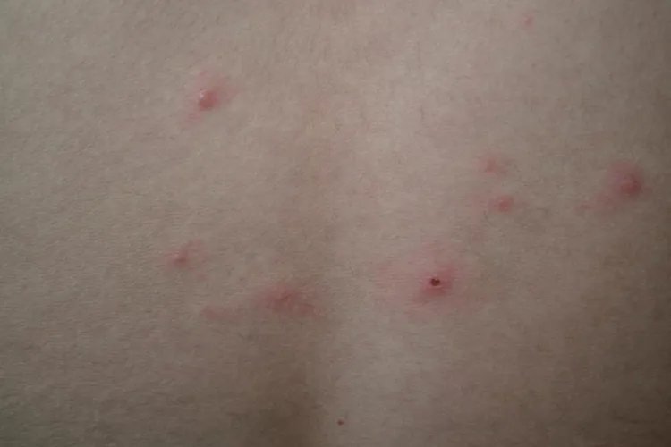 水痘子的症状图片