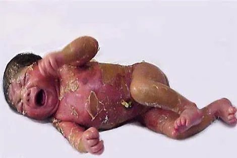 火棉胶婴儿真实图片