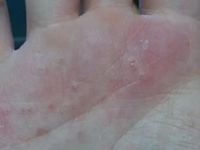 手部湿疹手掌小水疱图片