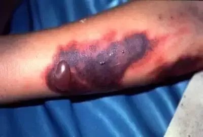 登革热皮肤症状图片