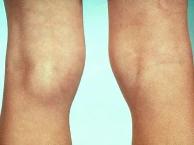 Ⅰ型痛性肥胖病症状图片