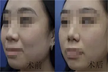 鼻头缩小术图