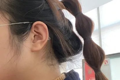 鬓角脱毛的前后对照图片