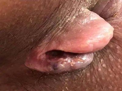 外痔症状图片