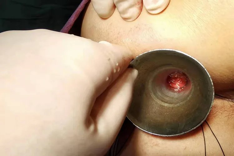 女性怎么判断自己得了痔疮图片