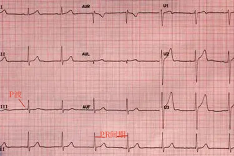 10种常见异常心电图