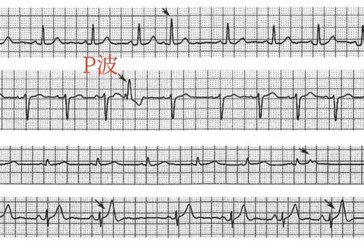 10种常见异常心电图