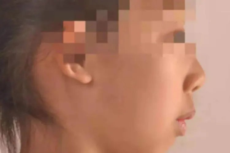 儿童腺样体面容图片