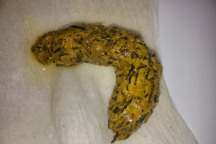 大便凹槽是什么样子的图解