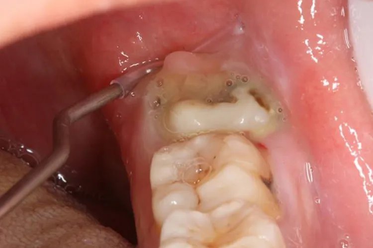 智齿冠周炎的症状图片