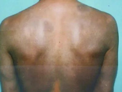 家族性进行性色素沉着症斑图片