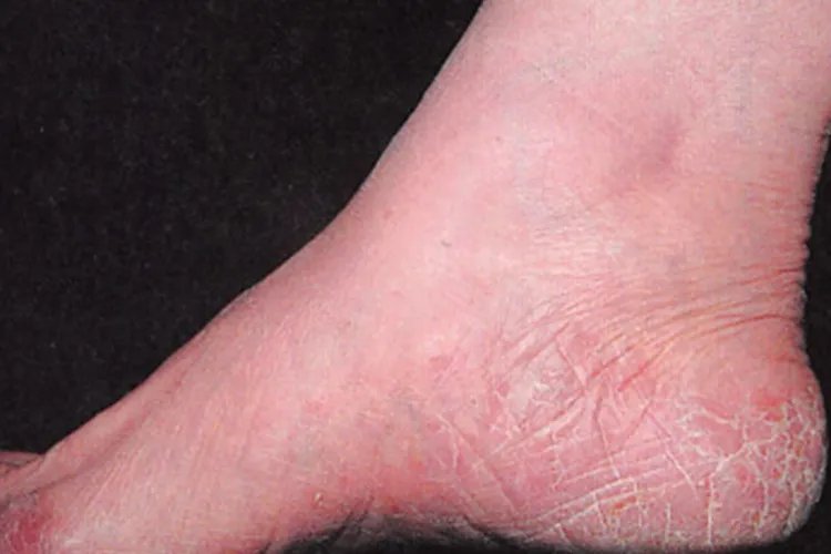 脚上起癣的图片和症状