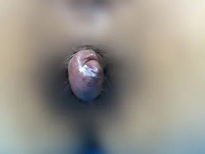外痔症状图片