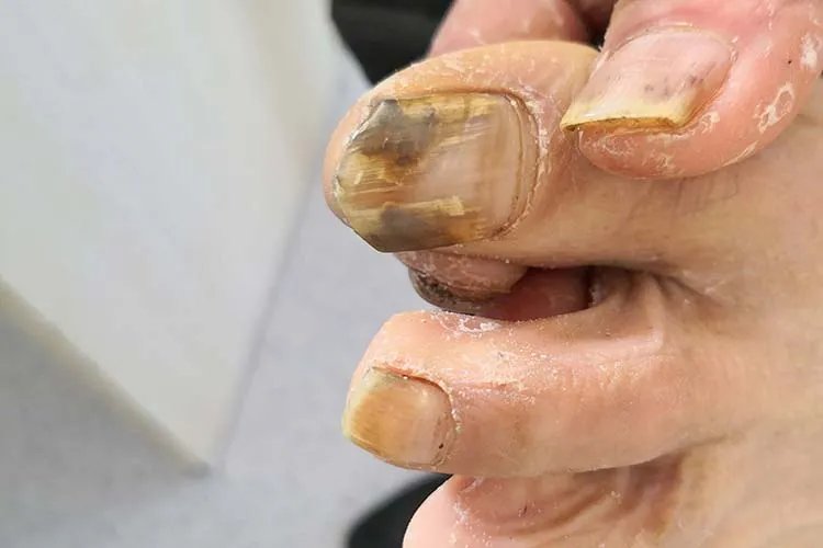 什么是灰指甲症状图片