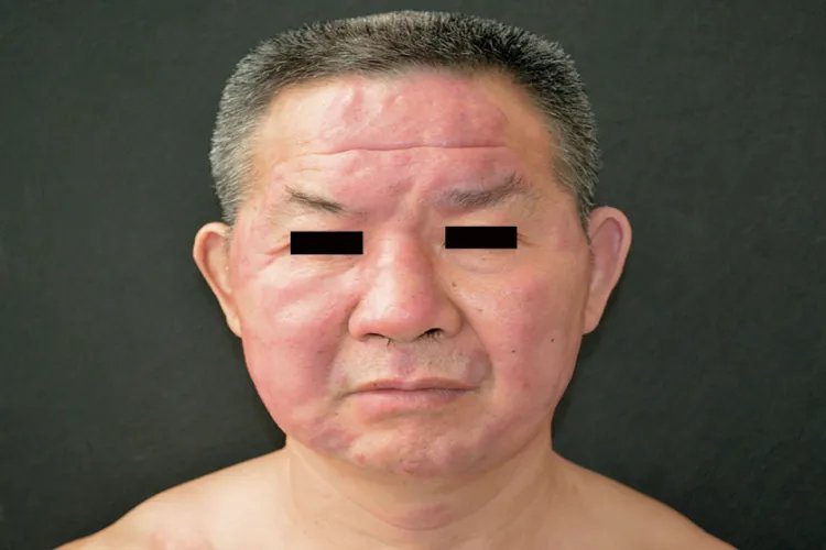 麻风病是什么病及图片