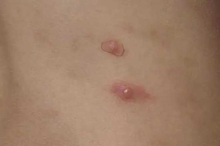 螨虫咬后的皮肤图片