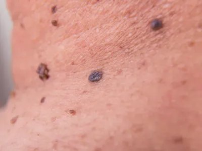 皮内痣颈部痣图片