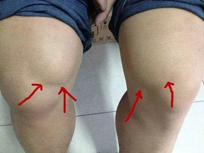 Ⅰ型痛性肥胖病症状图片