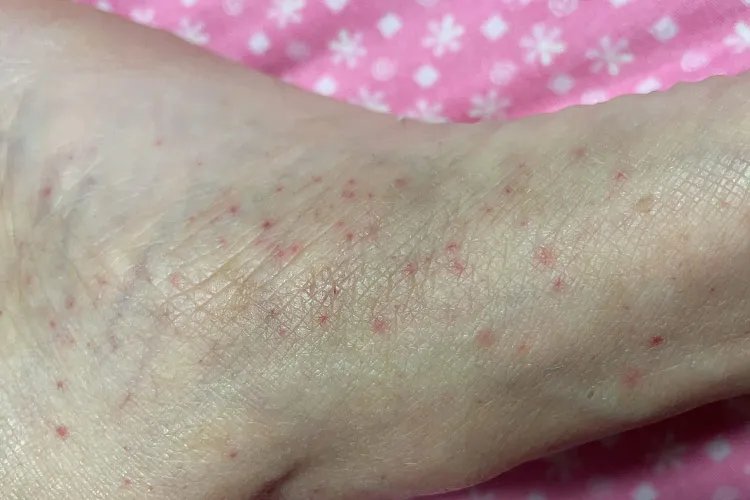 紫癜的早期症状图片