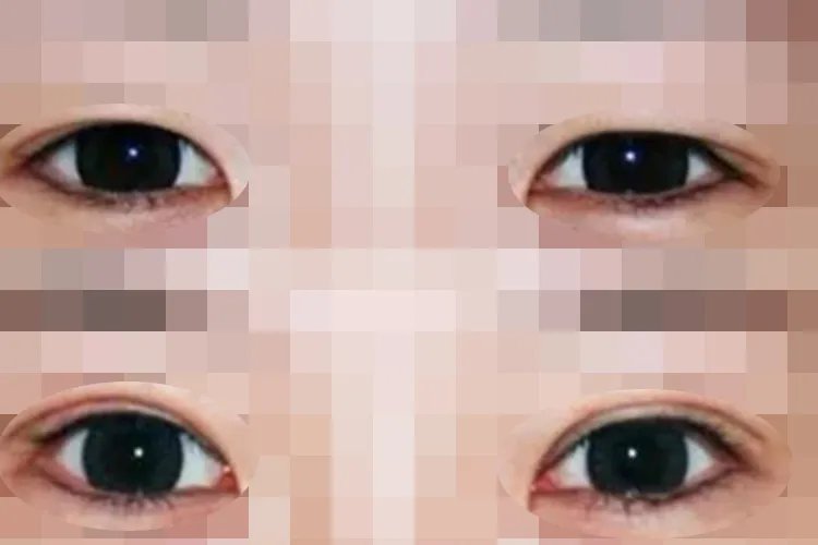 开内眼角前后对比效果图