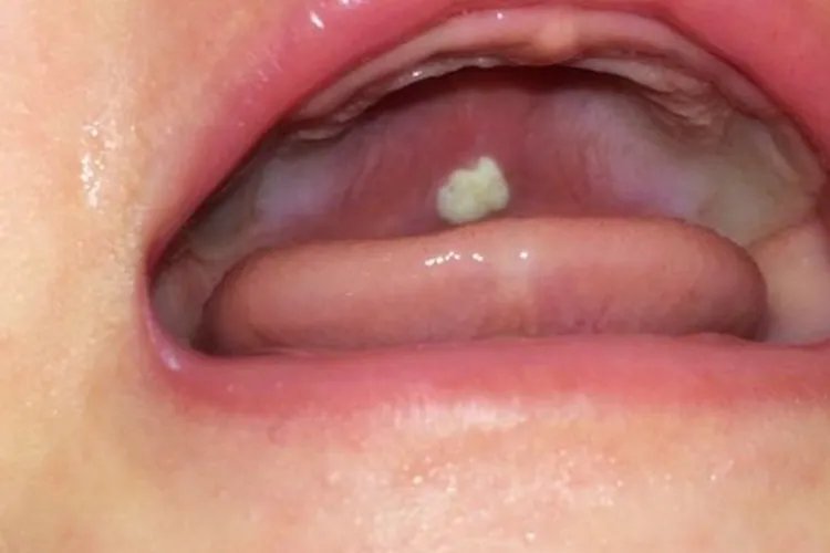 口腔白色念珠菌图片