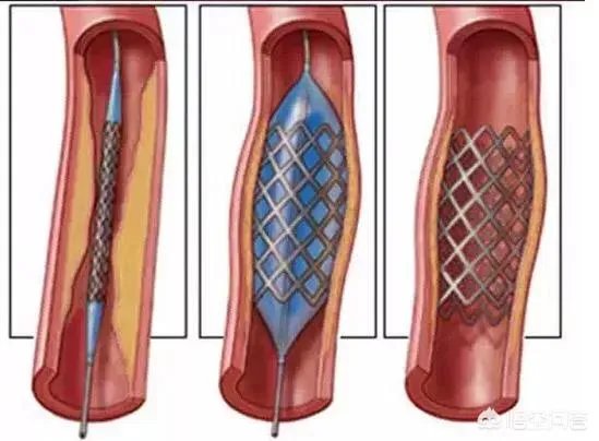 作为医生，你们见过的最幸运的病人有多幸运？