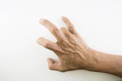 手指变形怎么恢复