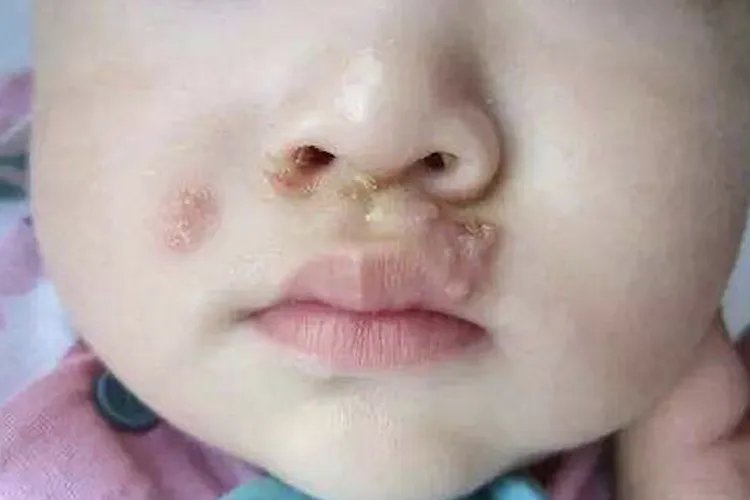 疱疹和上火水疱的区别图