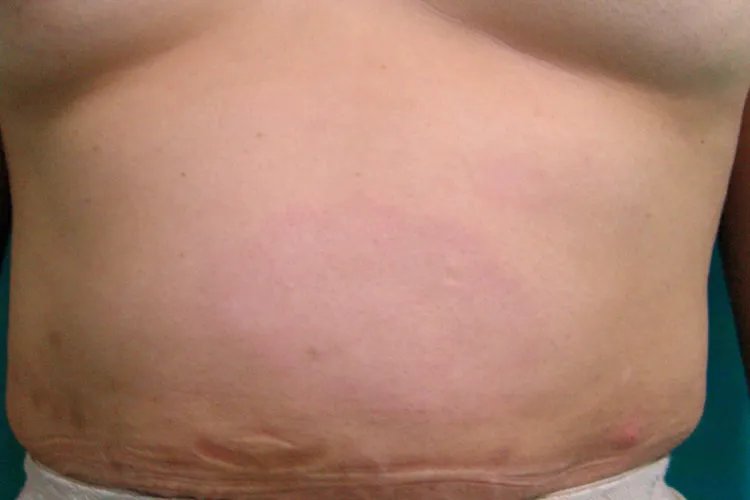 麻风病是什么病及图片