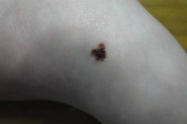 痣什么样子图片