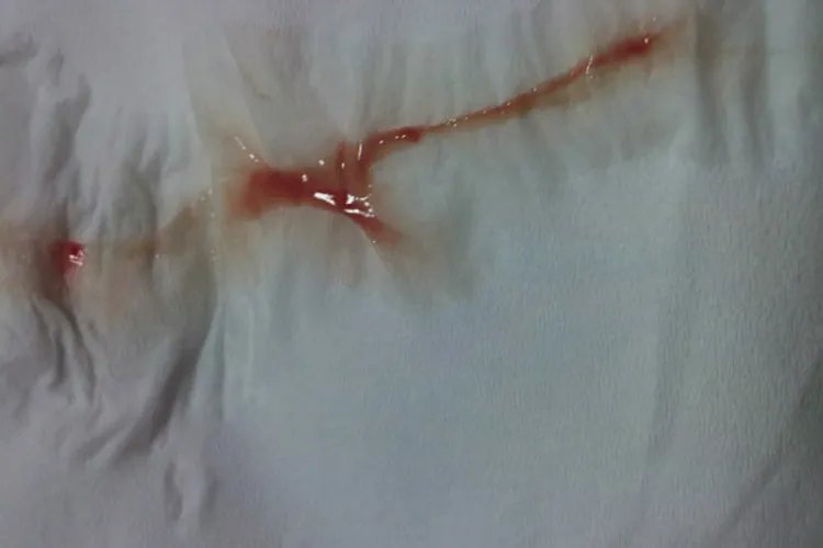 宫颈癌早期排液什么样的图片