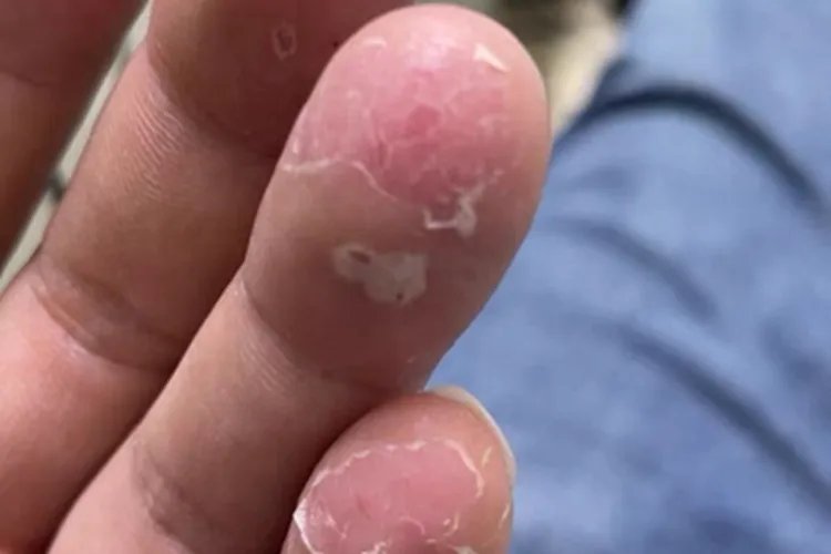 水疱型手癣症状图片