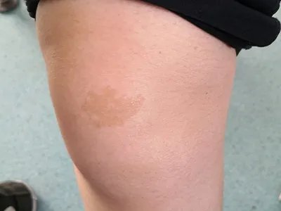 咖啡斑症状图片